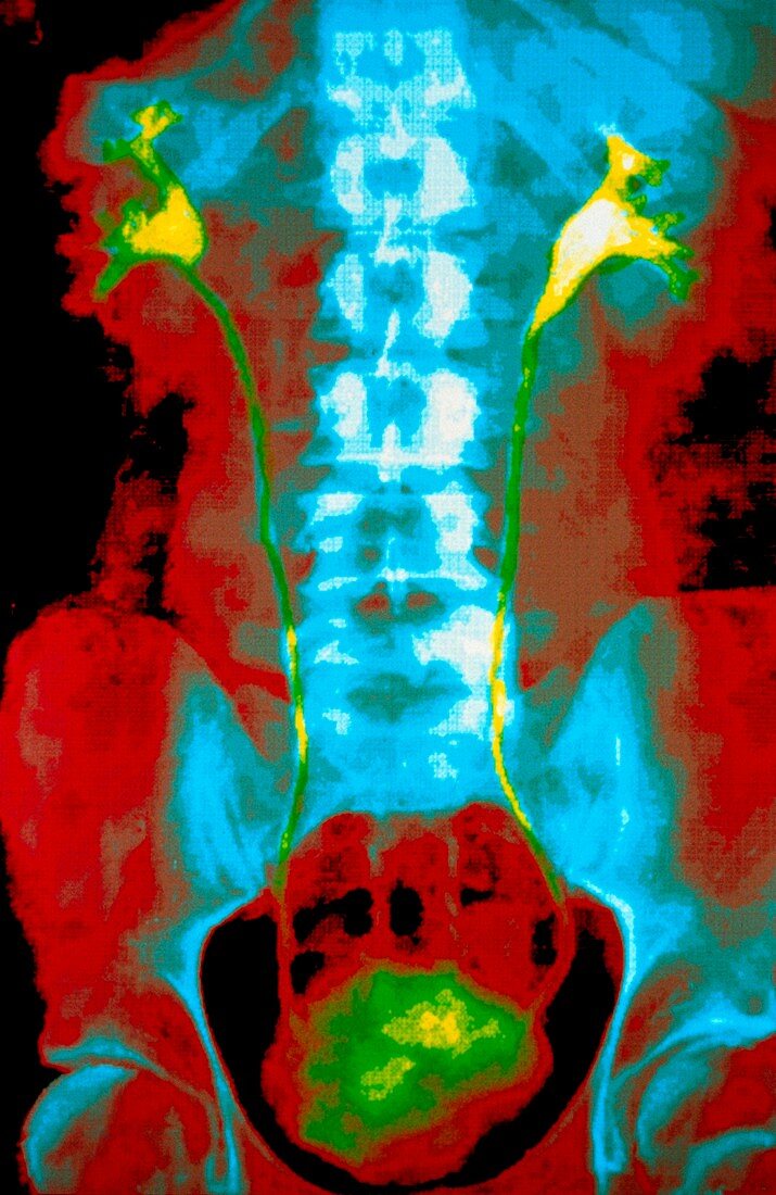 Coloured intravenous urogram of normal kidneys