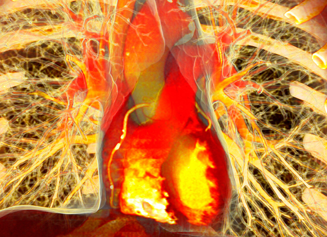 Heart and lungs,CT scan