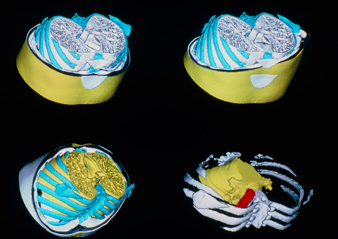 3-D CT scan of normal chest showing lungs