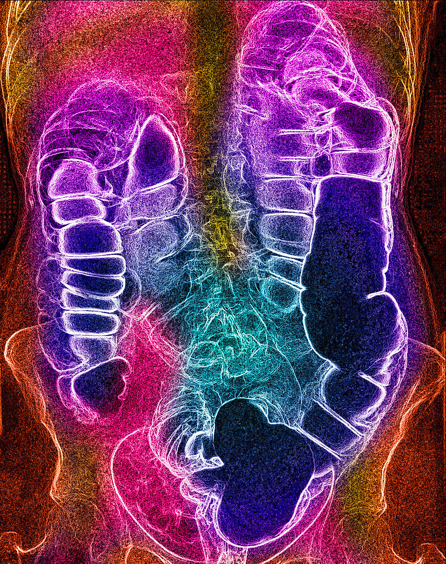 Coloured X-ray of the colon after a barium enema