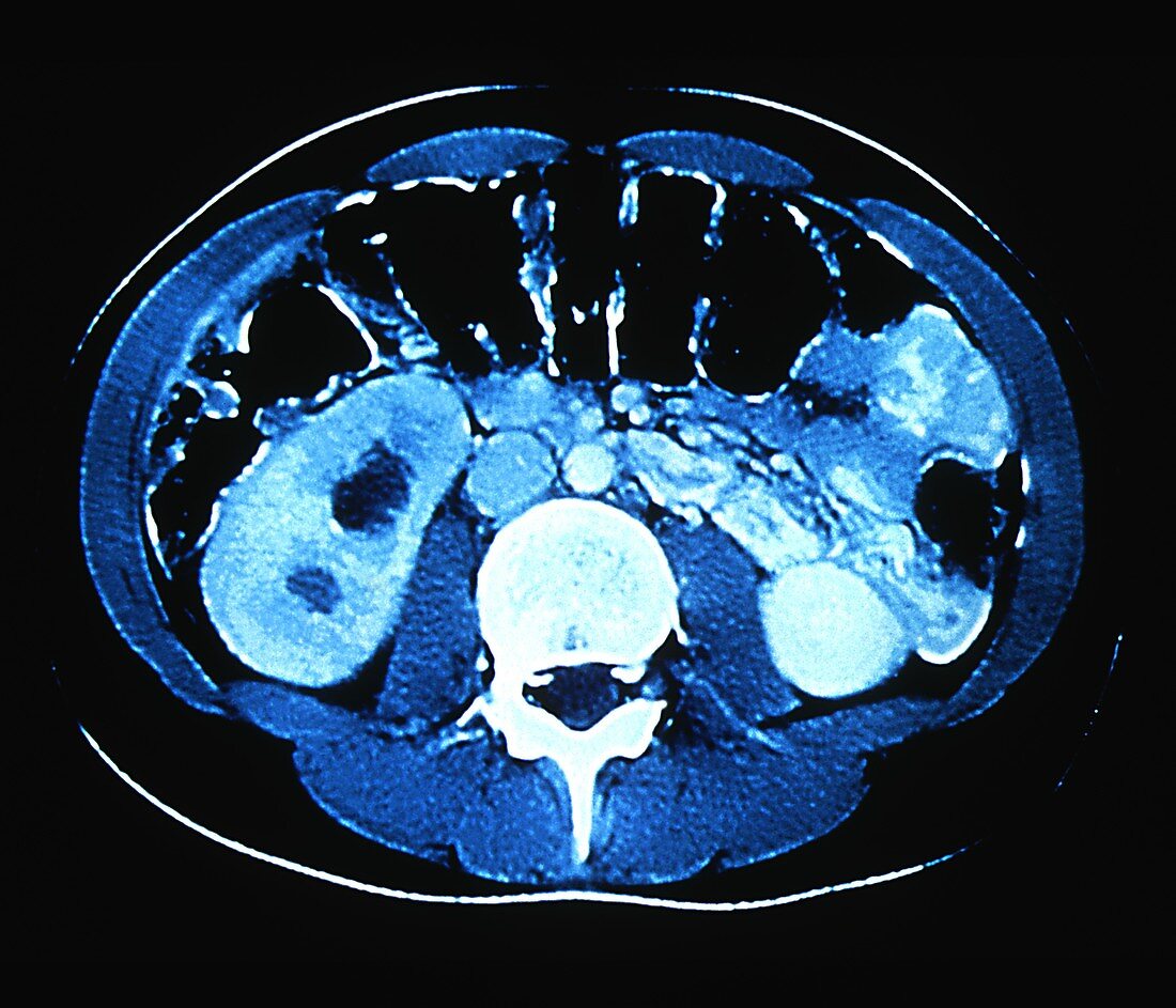 Healthy colon,CT scan