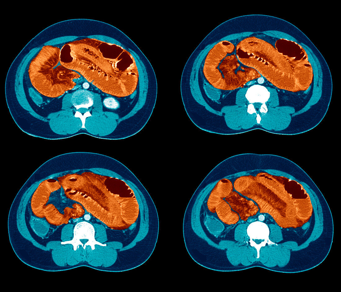 Healthy colon,CT scan