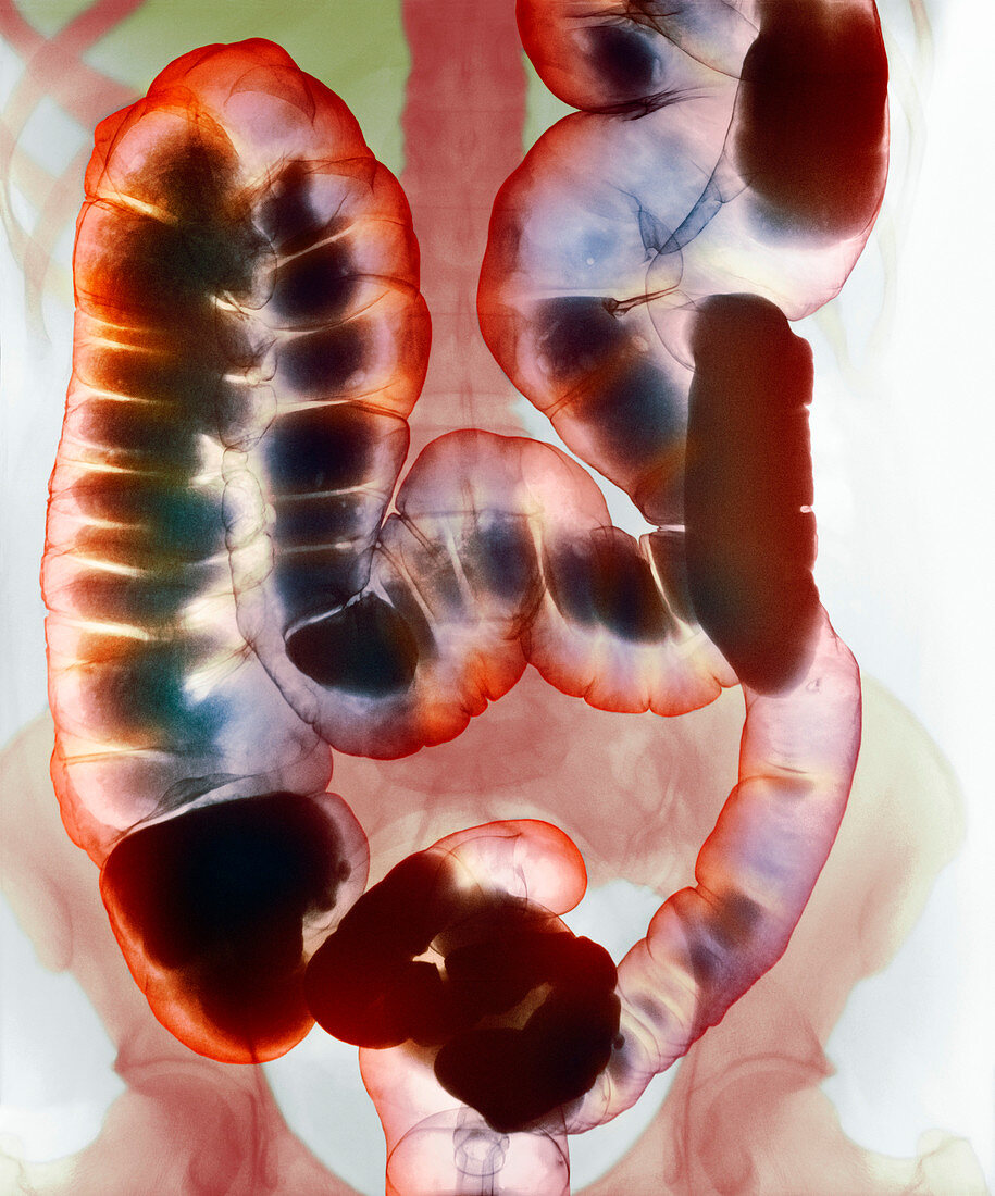 Healthy large intestine,barium X-ray