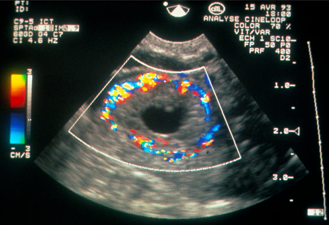 Doppler ultrasound of corpus luteum in the ovary