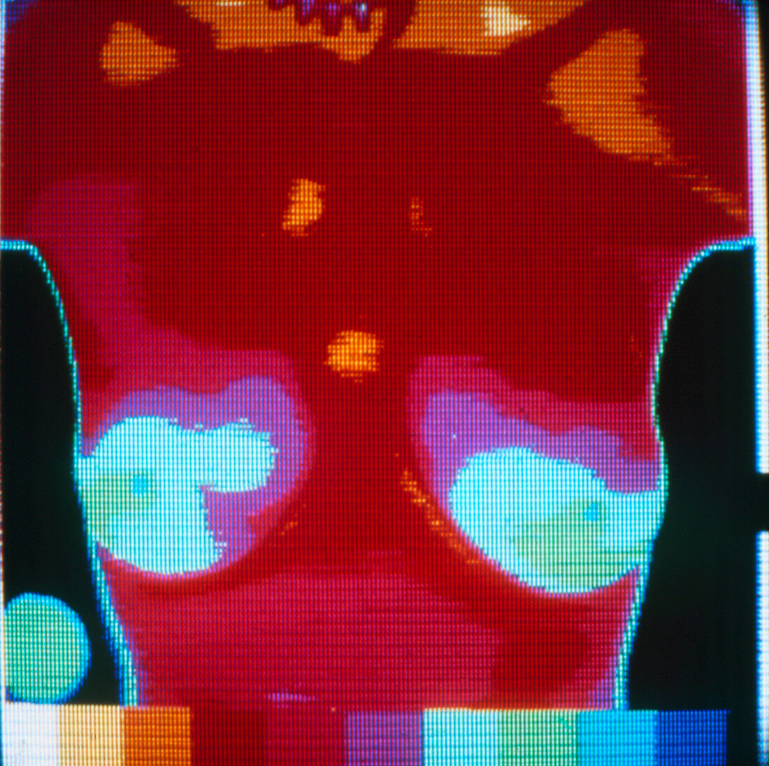 Breast thermogram