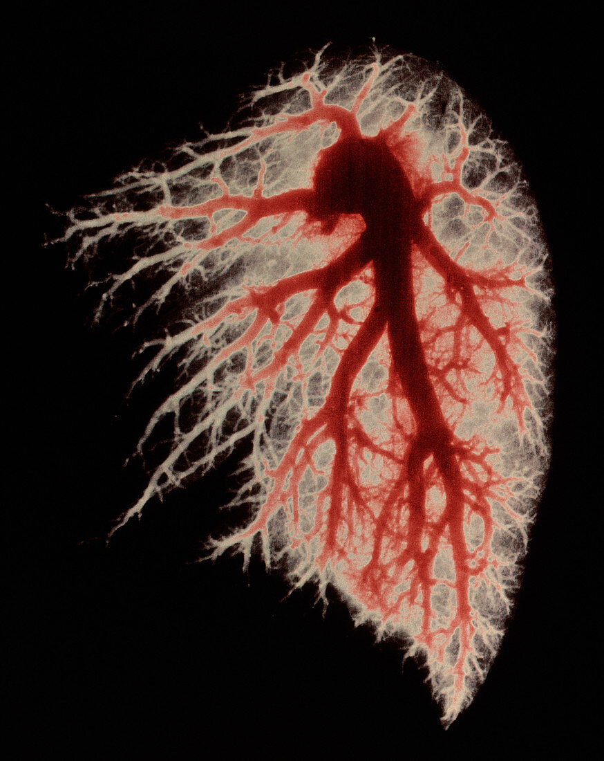 Coloured angiogram of pulmonary arteries of lung