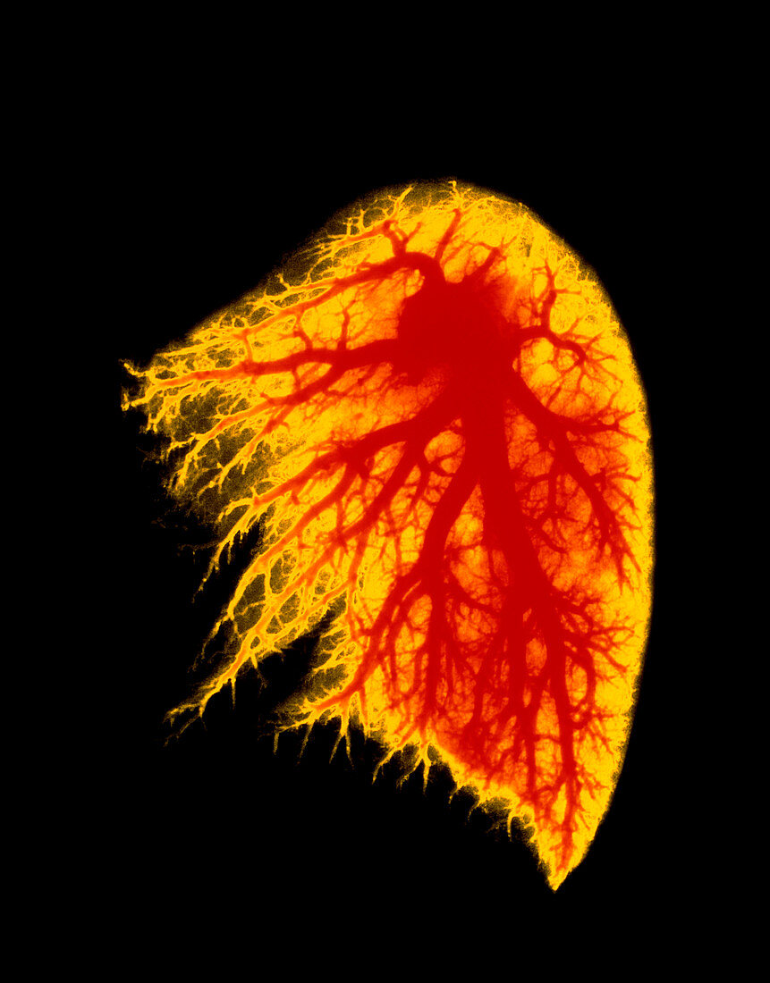 Coloured angiogram of pulmonary arteries of lung