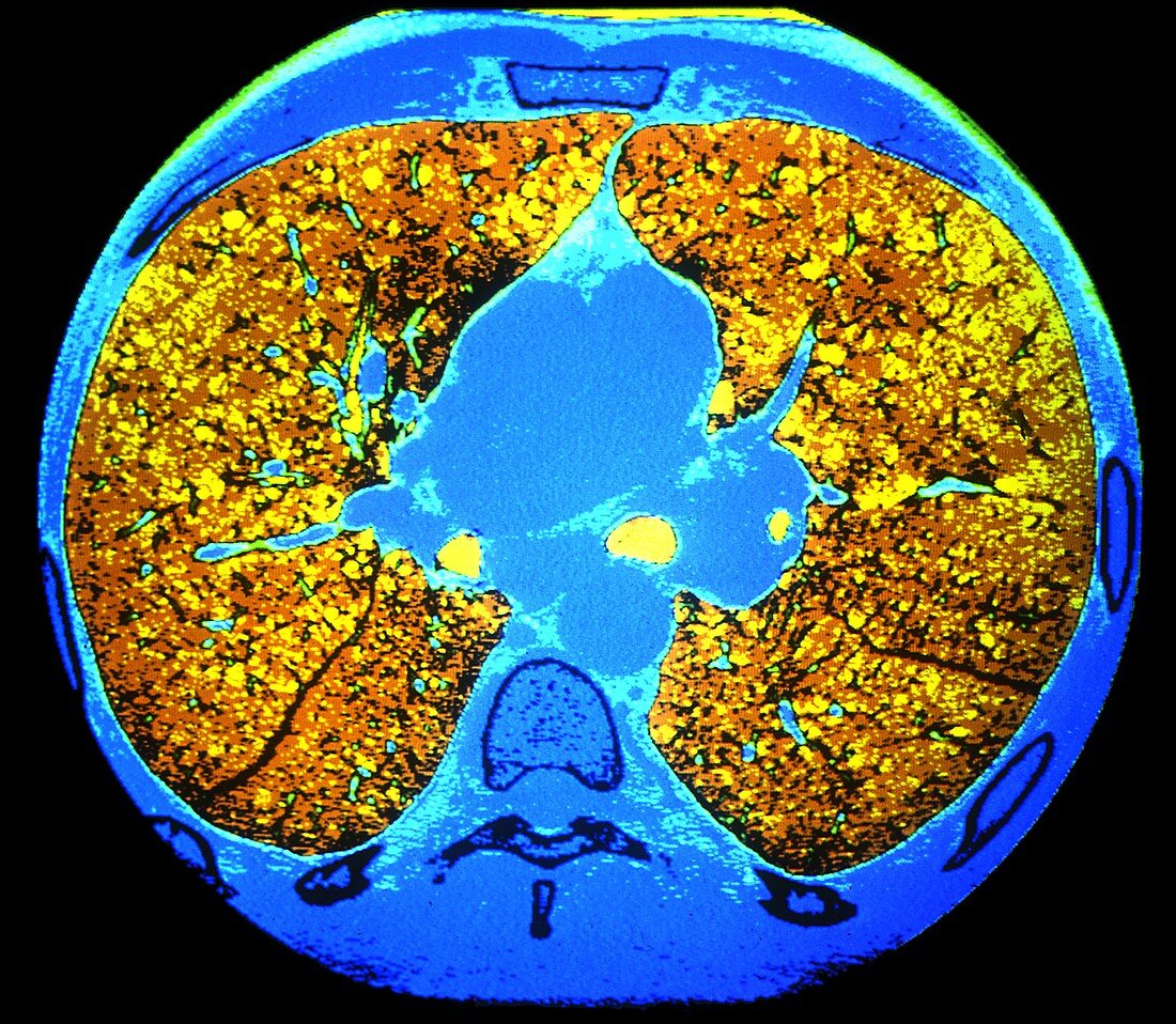 Lungs,CT scan