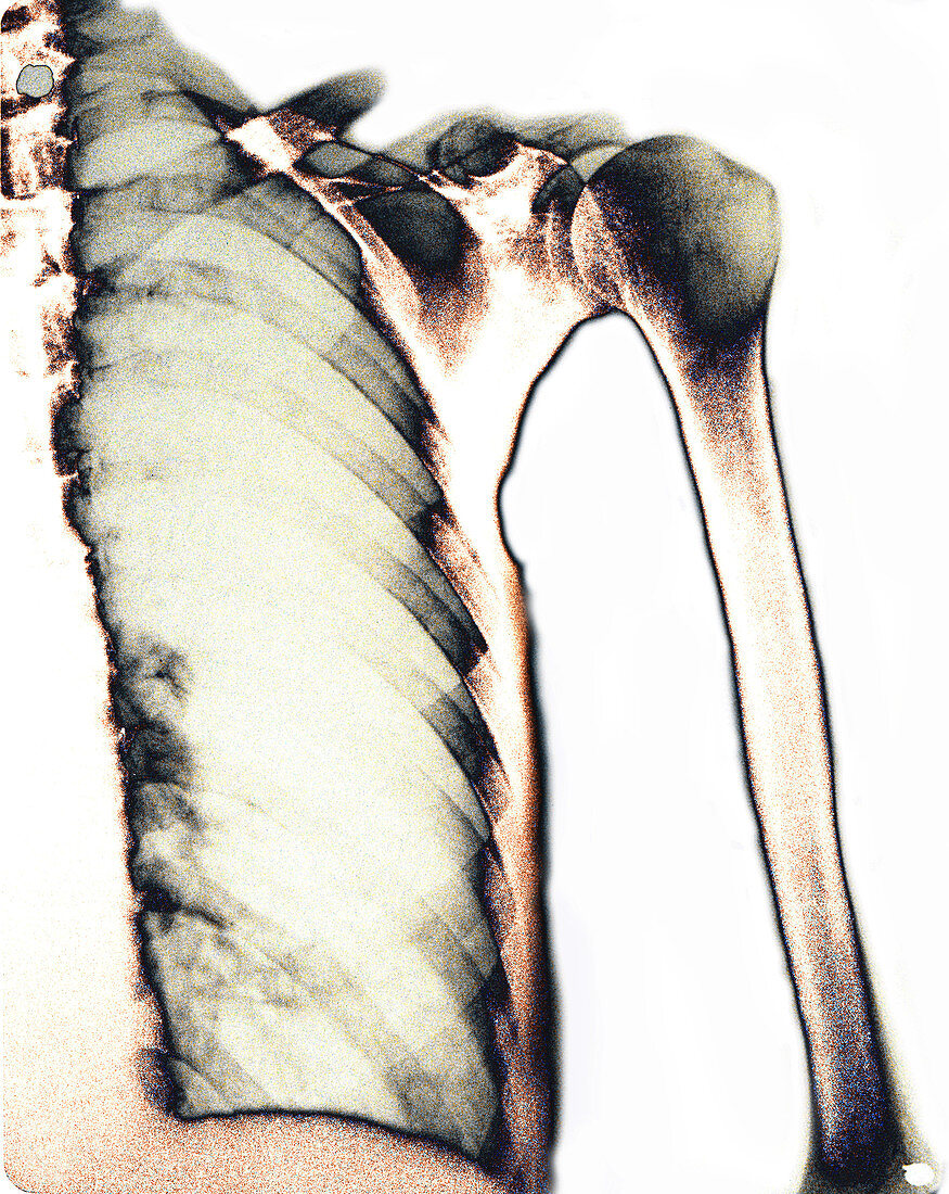 Healthy lung,X-ray