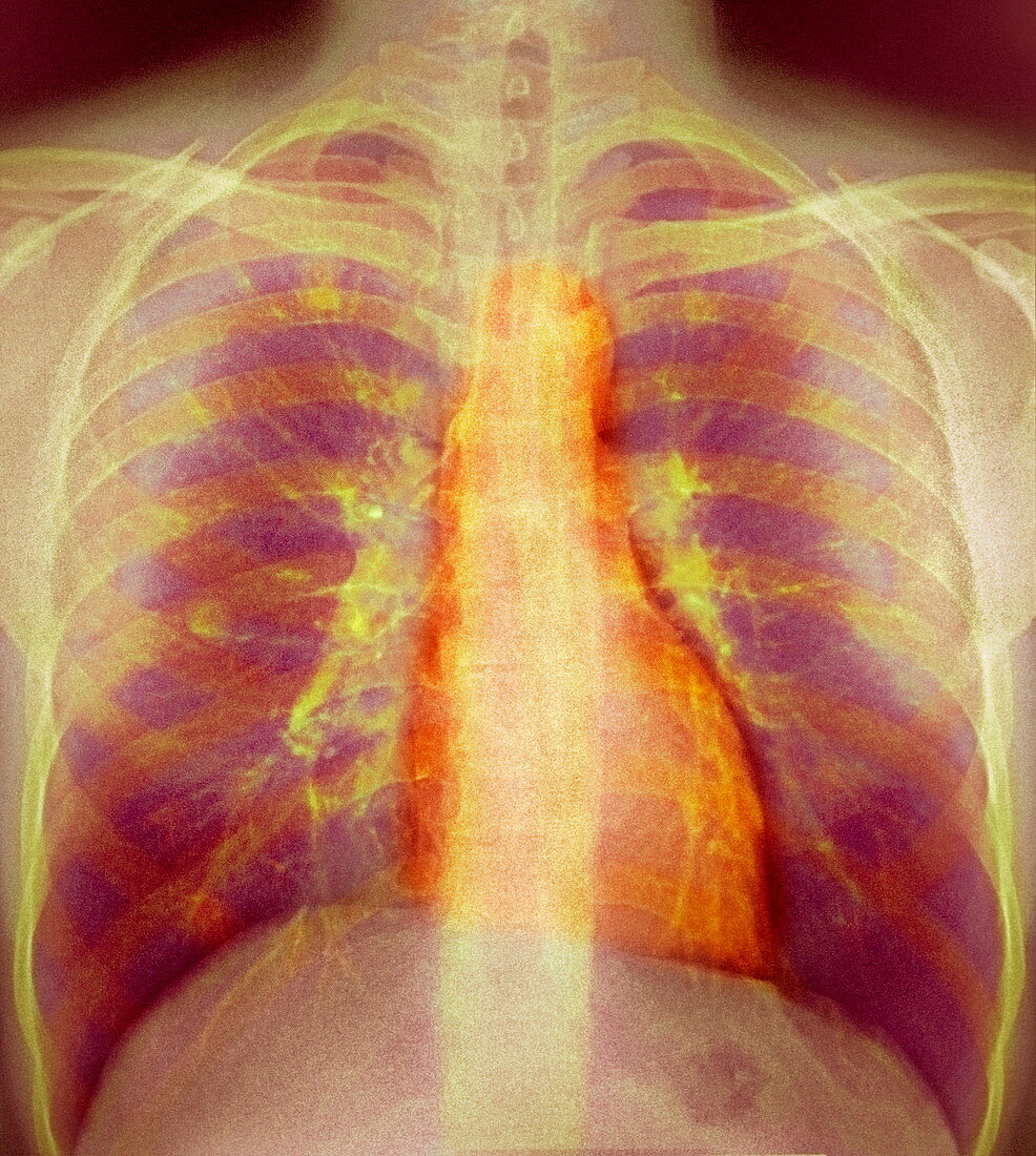 Breathing,X-ray