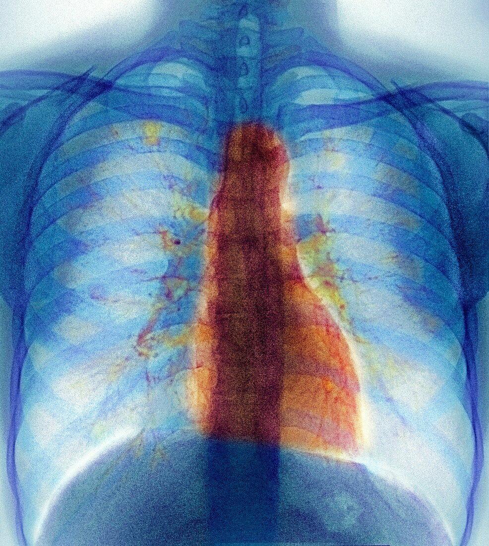 Breathing,X-ray