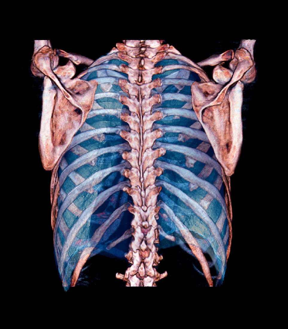 Lungs and thorax bones,3D CT scan
