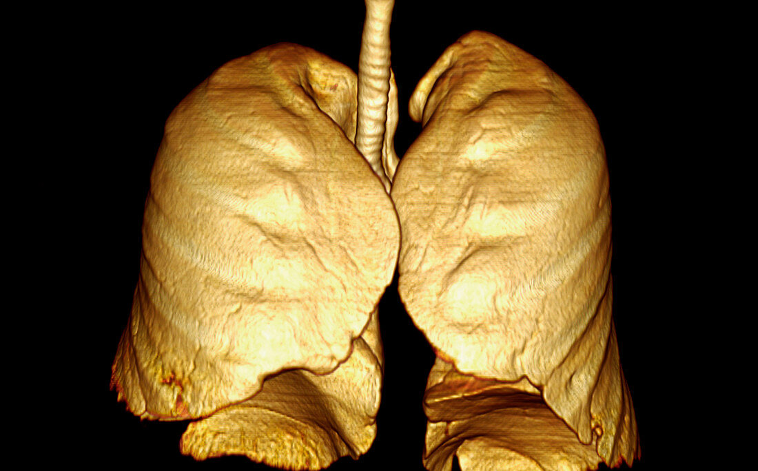 Lungs,CT scan