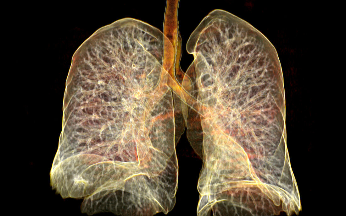Lungs,CT scan