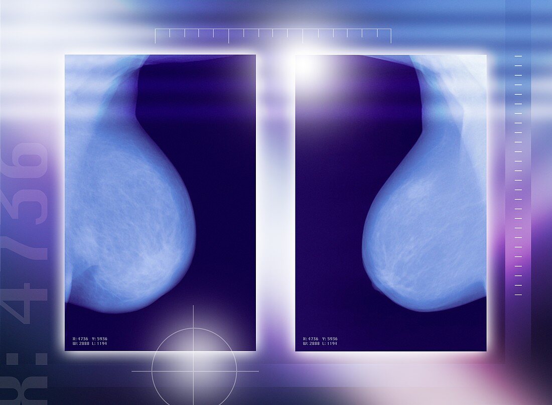 Healthy breasts,X-rays