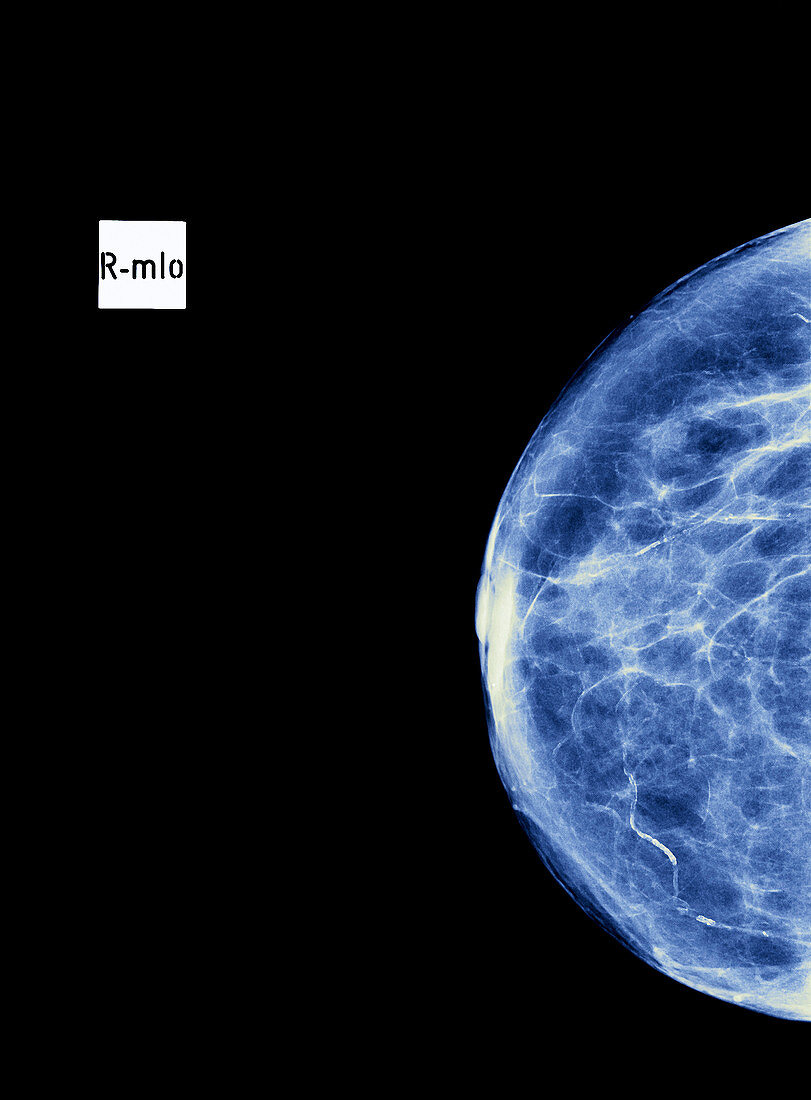 Normal breast,X-ray