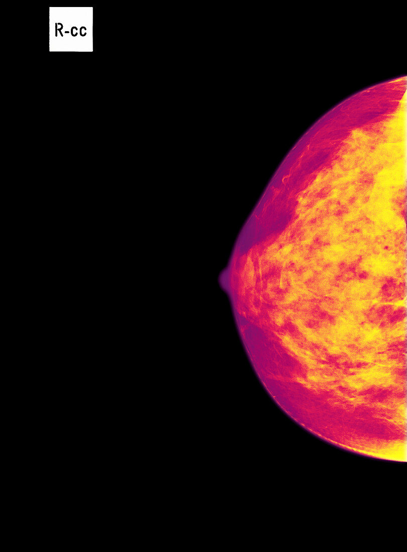 Normal breast,X-ray