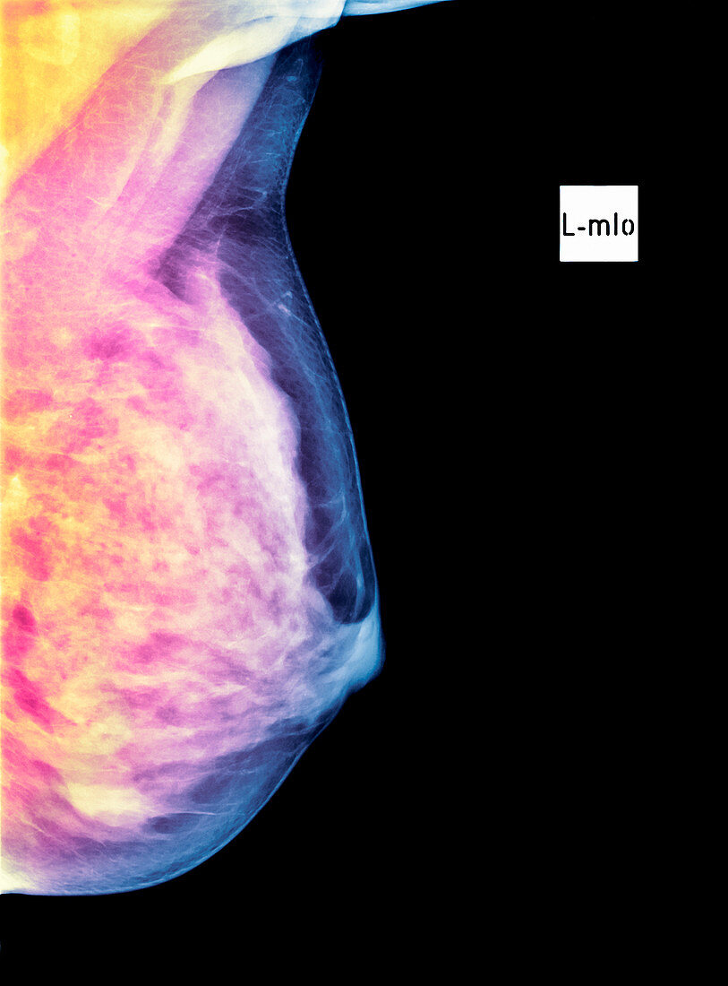 Normal breast,X-ray