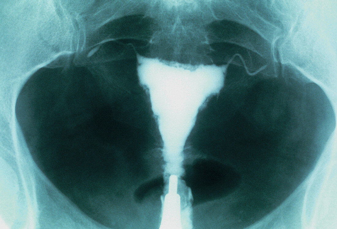 Post-menopausal uterus,X-ray
