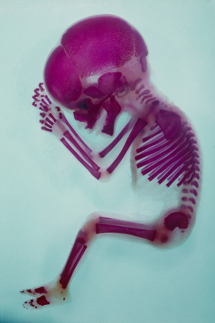 X-ray of aborted foetus
