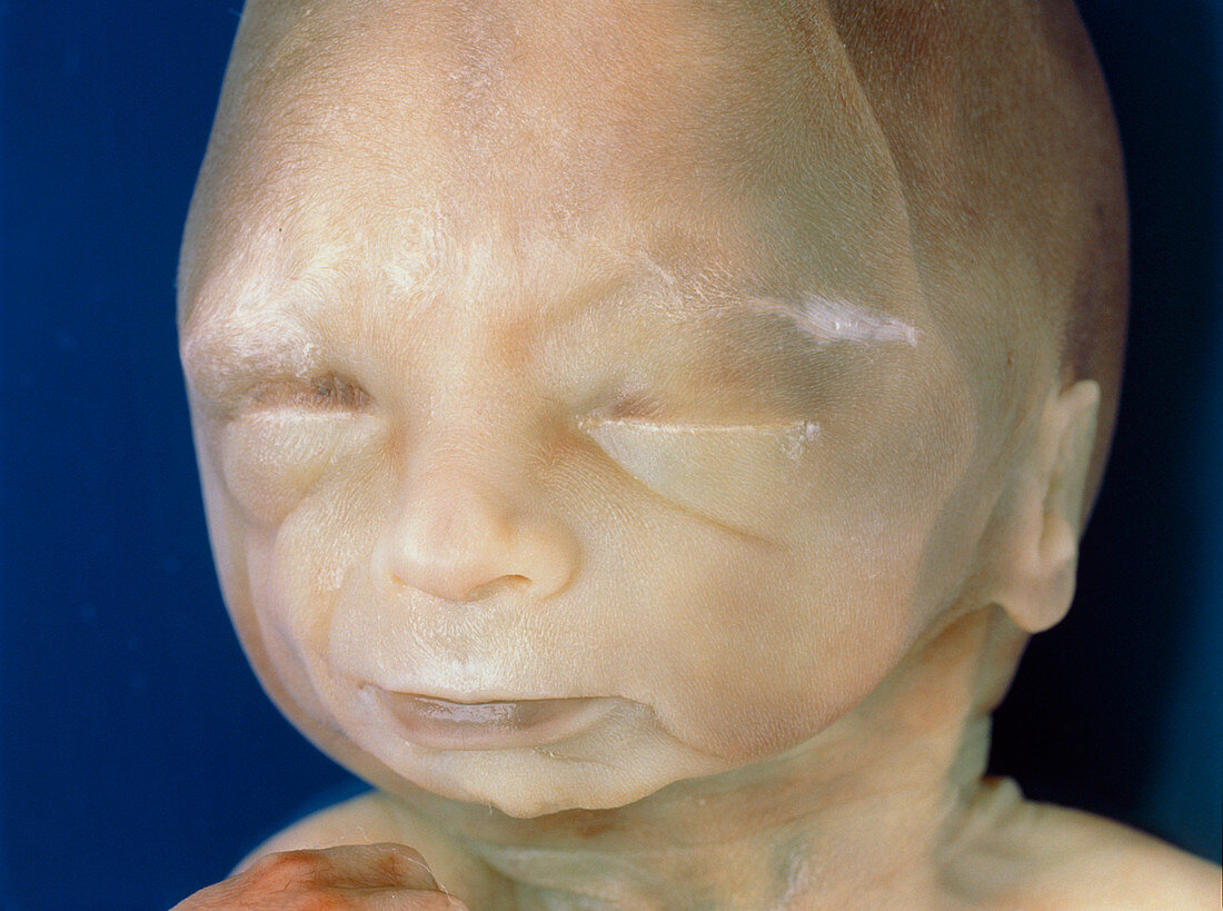 Face of a 20 week old human foetus