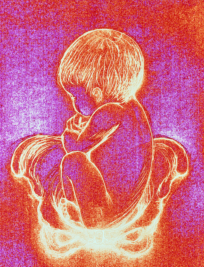 Artwork showing foetus in the breech position