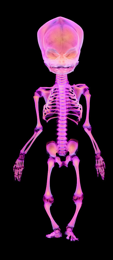 Coloured X-ray of a full-term stillborn foetus