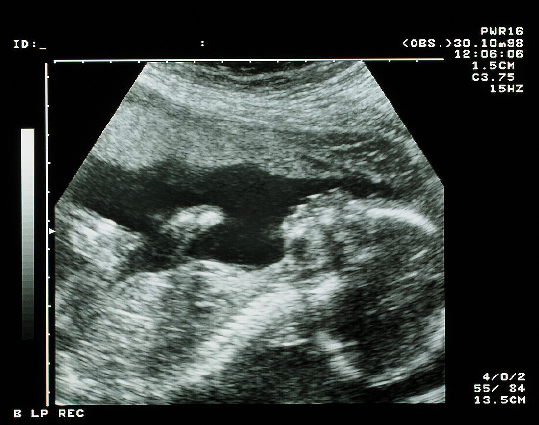 Ultrasound scan of 20 week old foetus sid