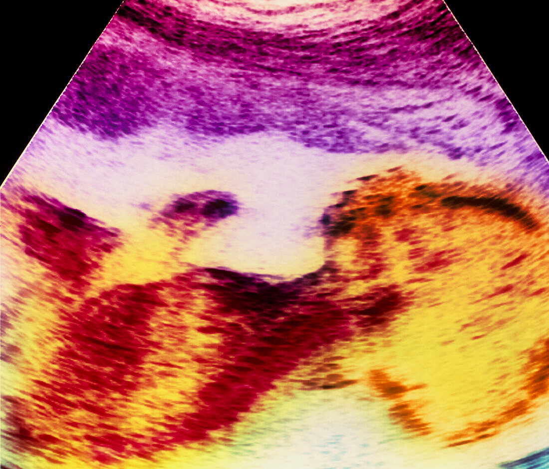 Ultrasound scan of 20 week old foetus (side view)