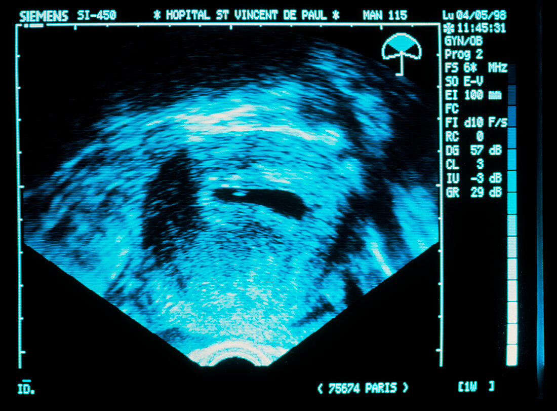 Ultrasound scan of an IVF embryo in the uterus