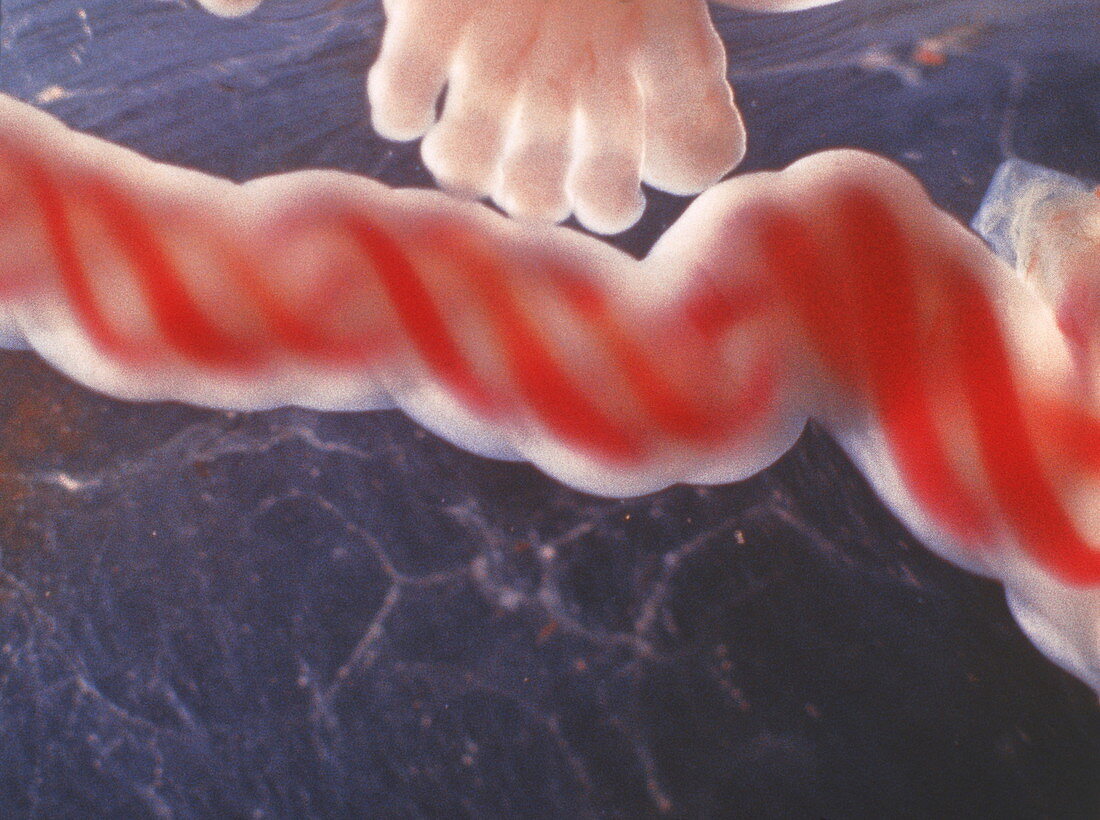 Umbilical cord of a foetus