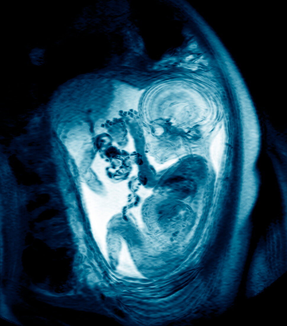 9 month foetus,MRI scan