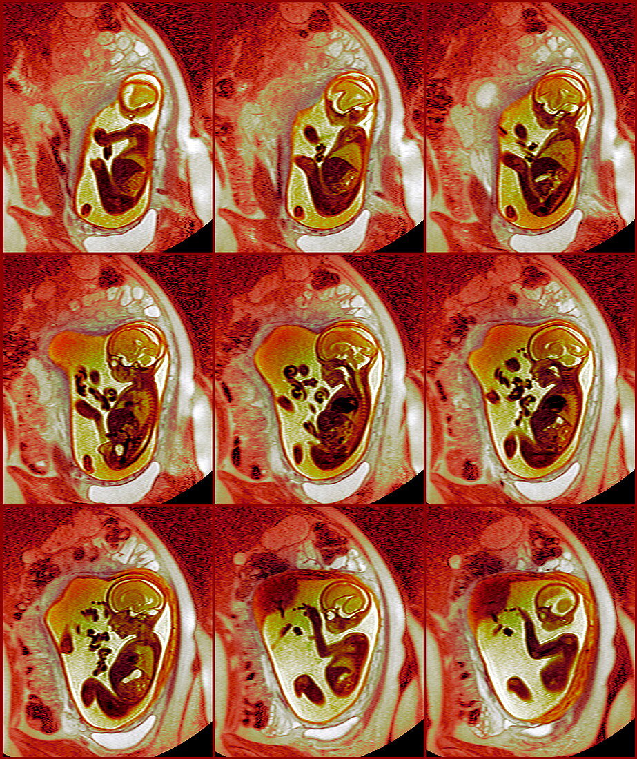 9 month foetus,MRI scans