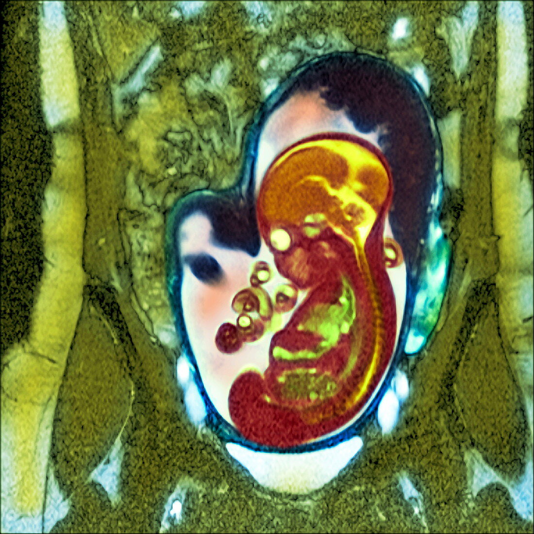 Abnormal foetus