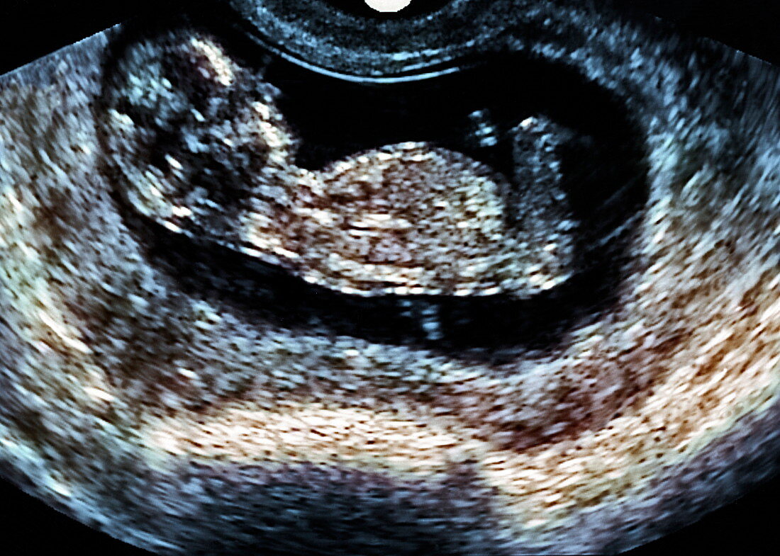 Foetal ultrasound