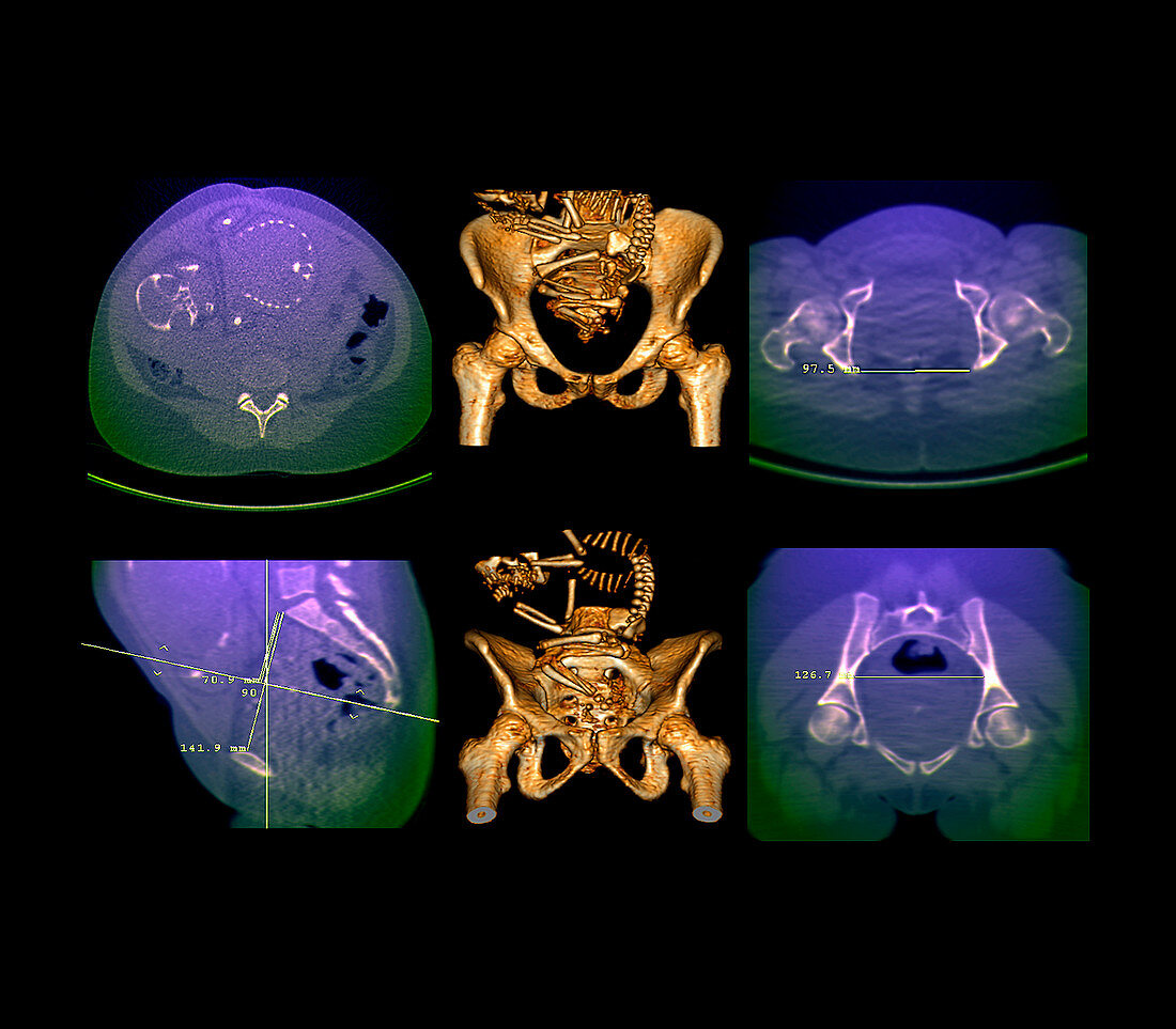 Breech position foetus,CT scans
