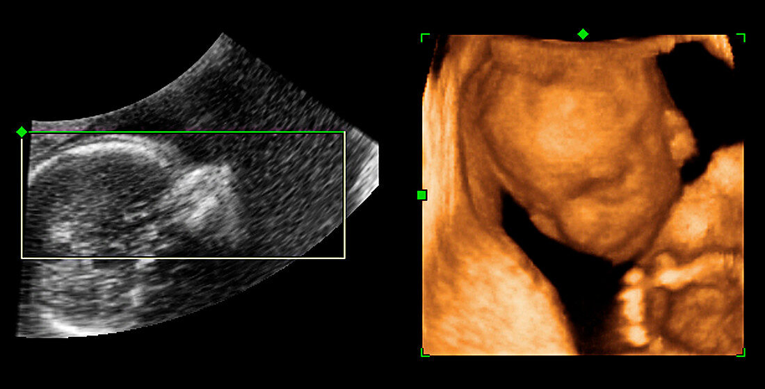 Foetus,2-D and 3-D ultrasound scans