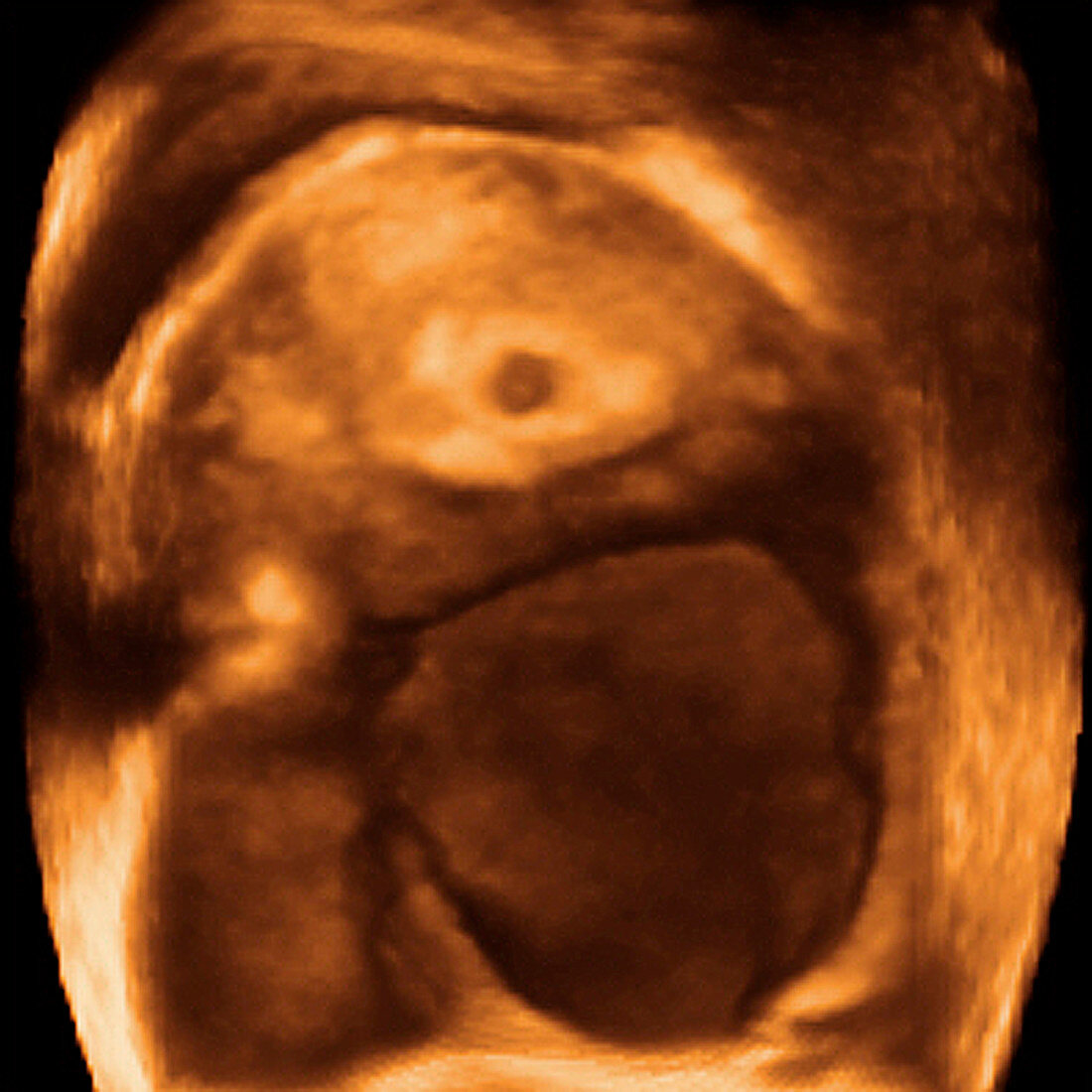 5 week embryo,3-D ultrasound scan