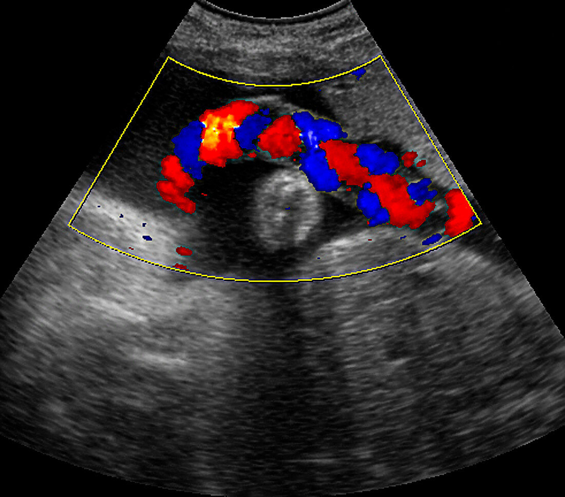 Umbilical cord blood flow,ultrasound