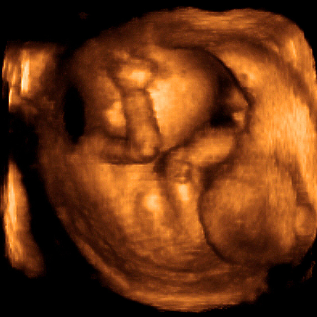 Foetus at 18 weeks,3-D ultrasound scan