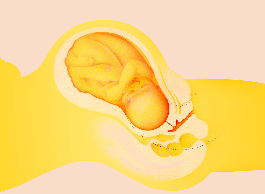 Full-term foetus