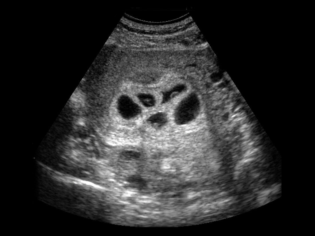 Quintuplet foetuses,ultrasound scan