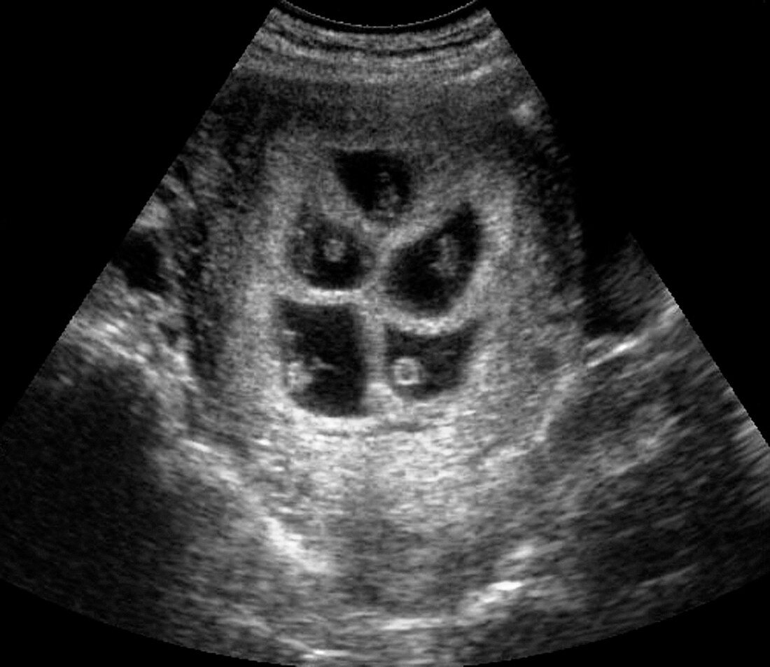 Quintuplet foetuses,ultrasound scan