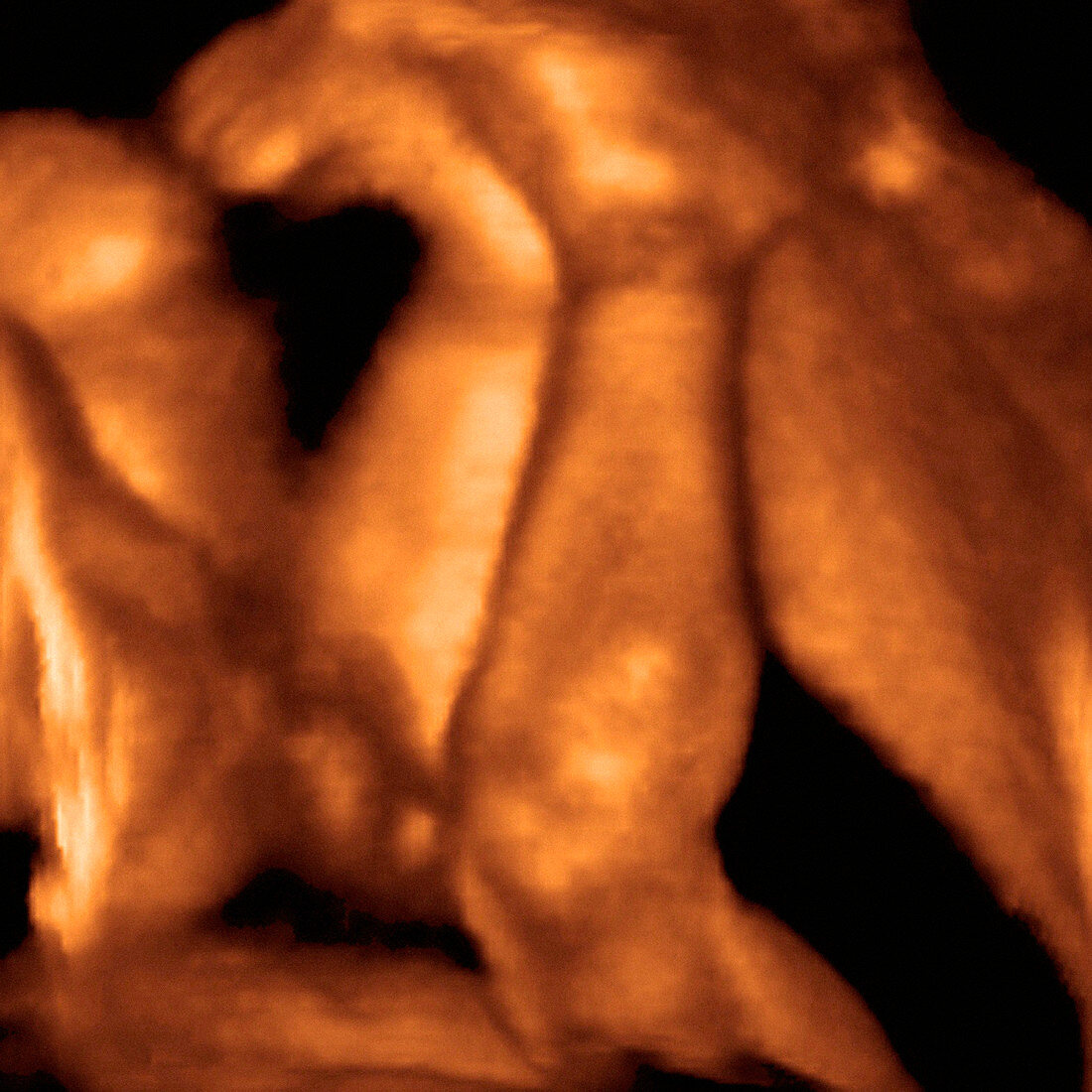 Foetus' legs,3-D ultrasound scan