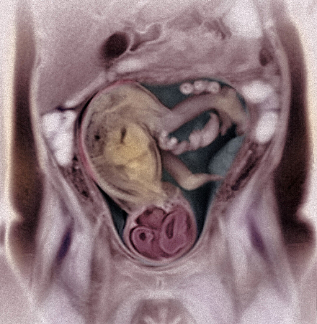 36 week foetus,MRI scan