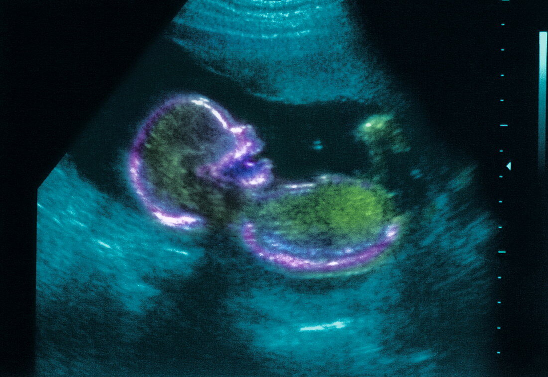 20 week foetus,ultrasound scan