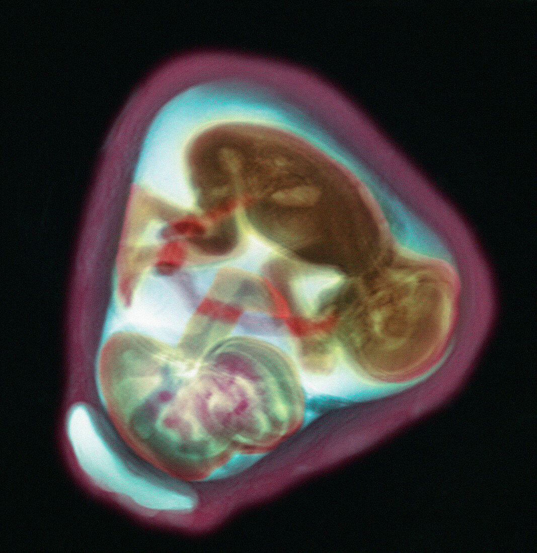 32 week twin foetuses,MRI scan