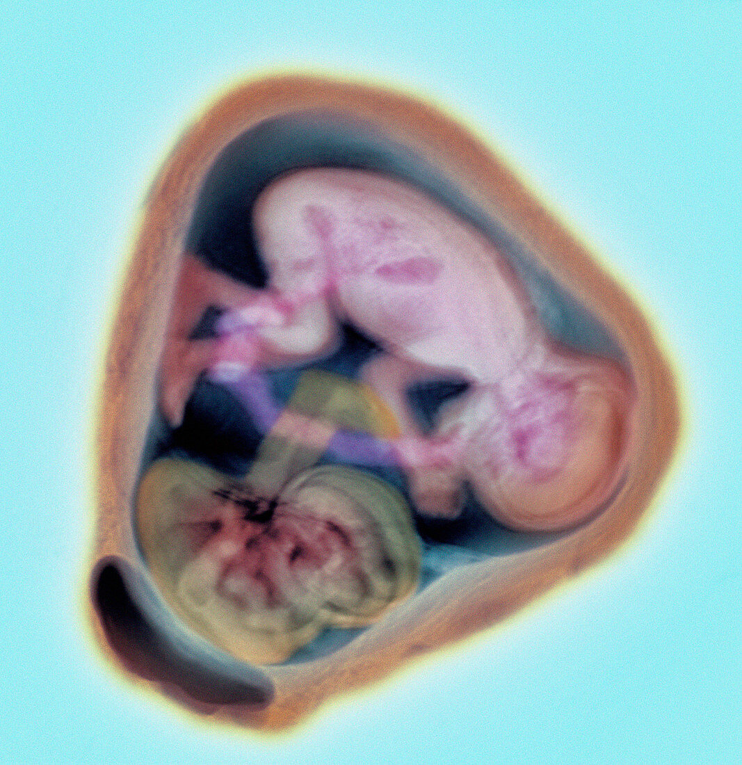32 week twin foetuses,MRI scan