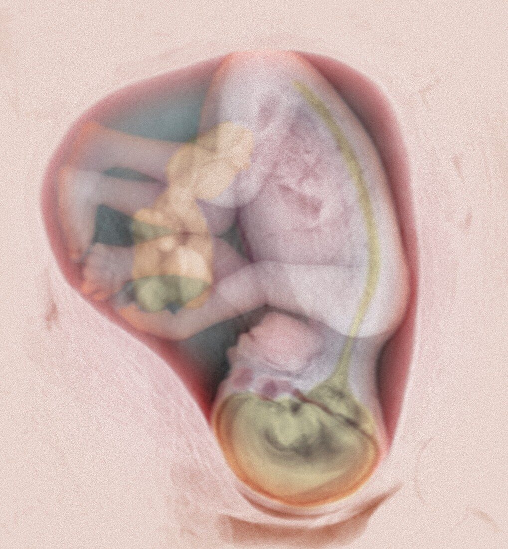 27 week foetus,3-D MRI scan