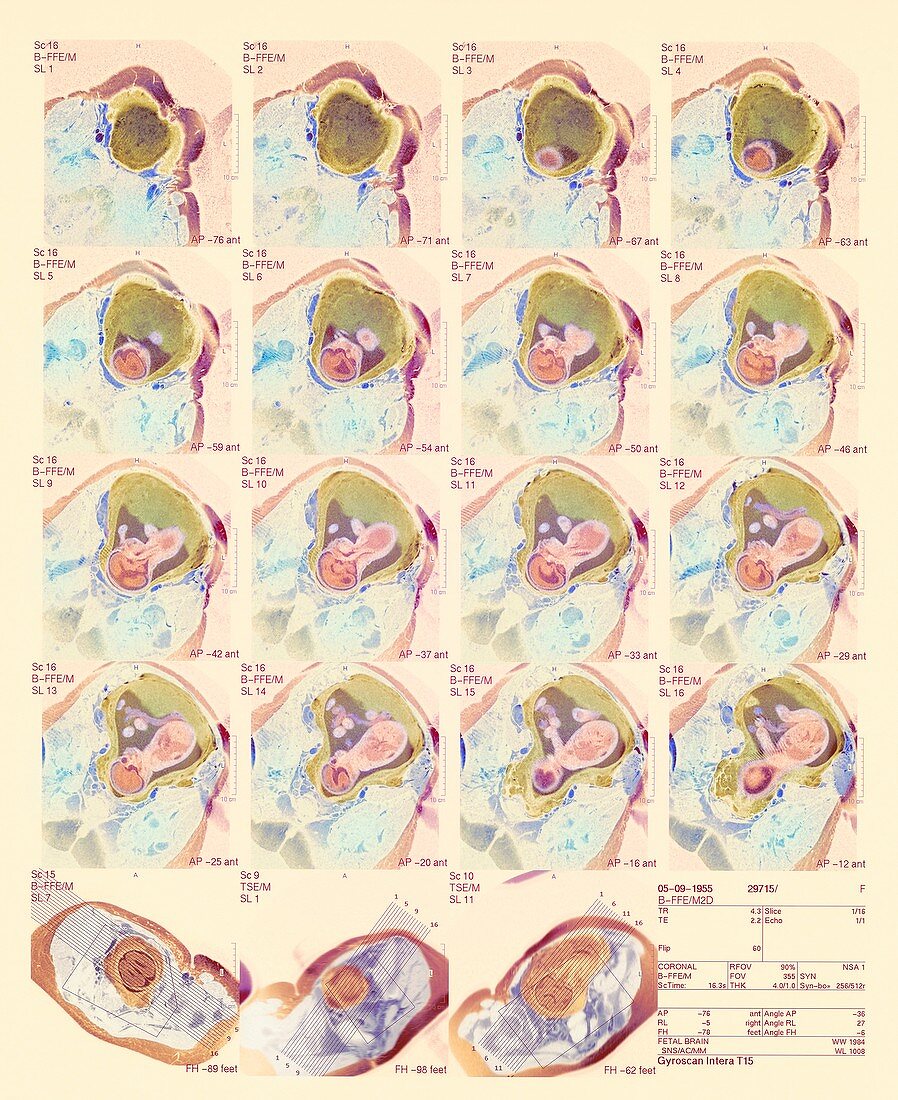 27 week foetus,MRI scans